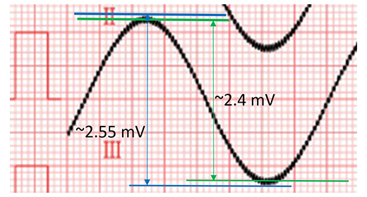 加並聯電路產生的 60Hz 干擾雜訊,需要取上下雜訊的平均值後再計算 Vpp 值 加並聯電路產生的 60Hz 干擾雜訊,需要取上下雜訊的平均值後再計算 Vpp 值